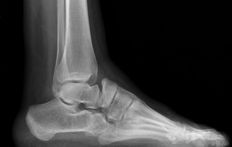Imagerie pathologie arriere pied CAS 17 Melle L 21 Ans Imagerie pathologie arriere pied CAS 17 Melle L 21 Ans